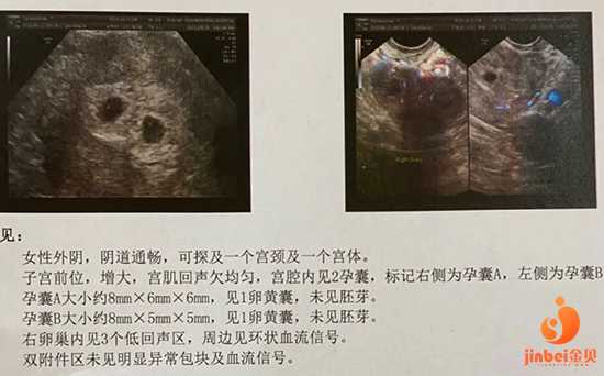 杭州代怀网站有几家|泰国试管婴儿如何生双胎？几点建议告诉你！
